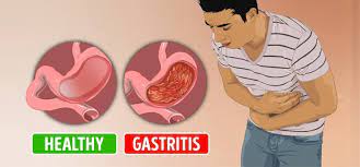 how to cure gastritis permanently